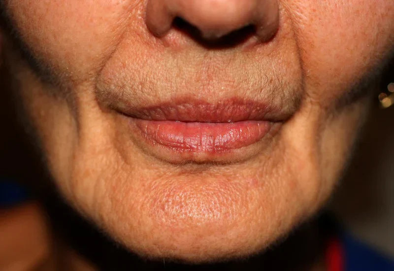 Joues Creuses Après 50 Ans : Comment Retrouver du Volume