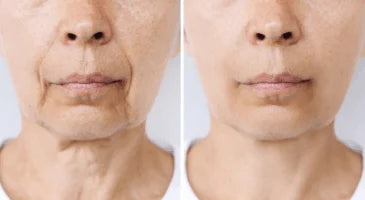 Alternative Naturelle au Botox : Des Résultats Sans Piqûres