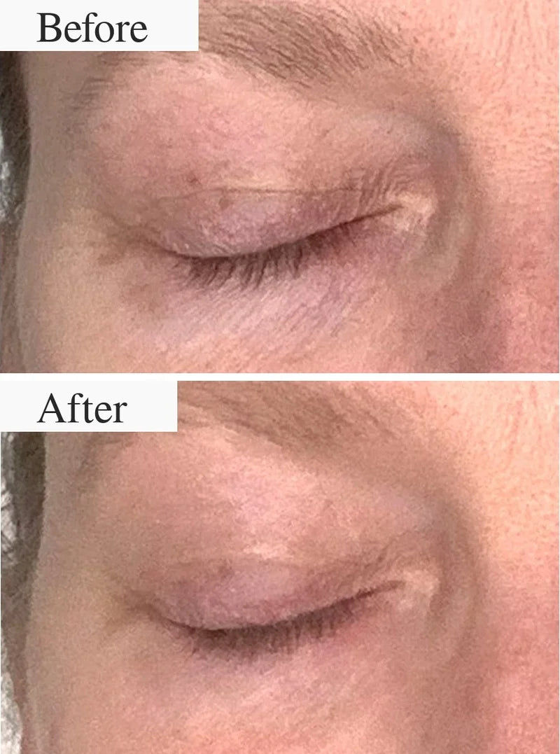 Contour des yeux après