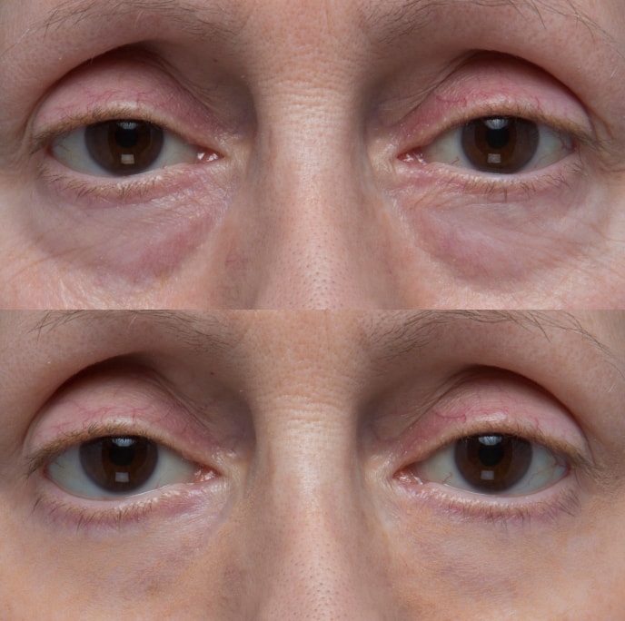 Avant apres contour des yeux